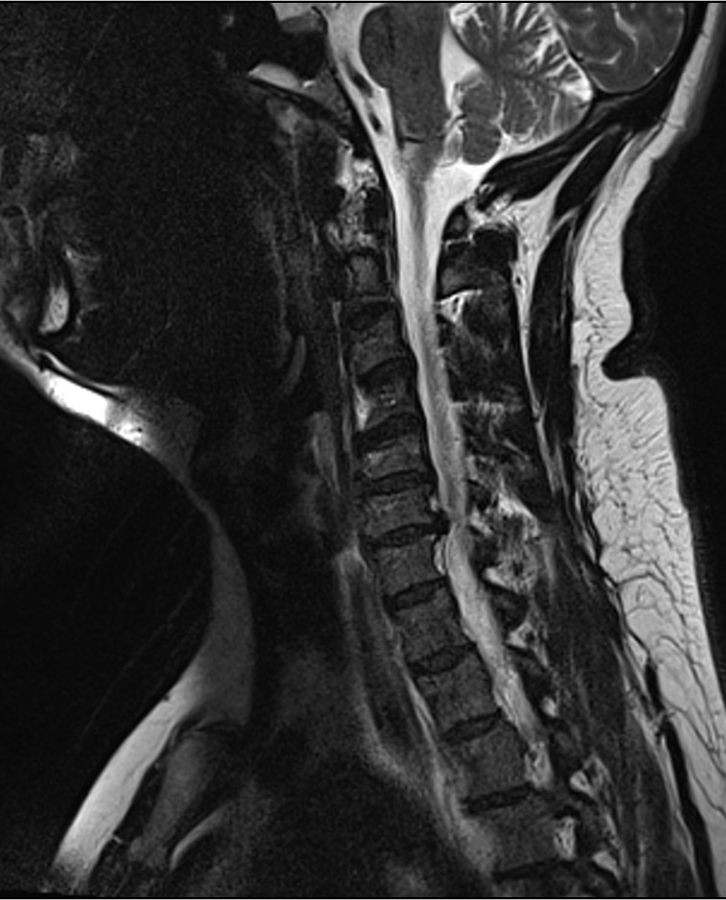 외부 공개 참고용 경추 MRI 영상